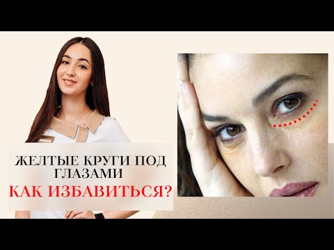 ЖЕЛТЫЕ КРУГИ ПОД ГЛАЗА 👁 🍋 КАК ИЗБАВИТЬСЯ ОТ КРУГОВ ПОД ГЛАЗАМИ⁉️