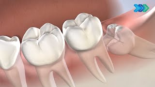 Post-Operative Instructions: Wisdom Teeth at Huntsville Oral Surgery & Dental Implants