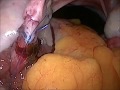 Laparoscopic tubal recanalization  tubectomy reversal  tuboplasty 