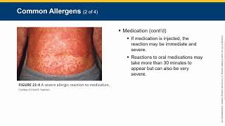 CH 21   EMT Allergy and Anaphylaxis