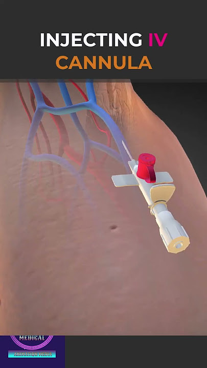 Kanula IV Disuntikkan dengan Plester Perekat #shorts #education