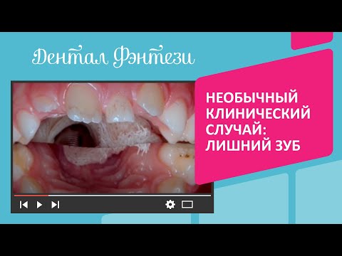 Видео: Какие синдромы связаны со сверхкомплектными зубами?
