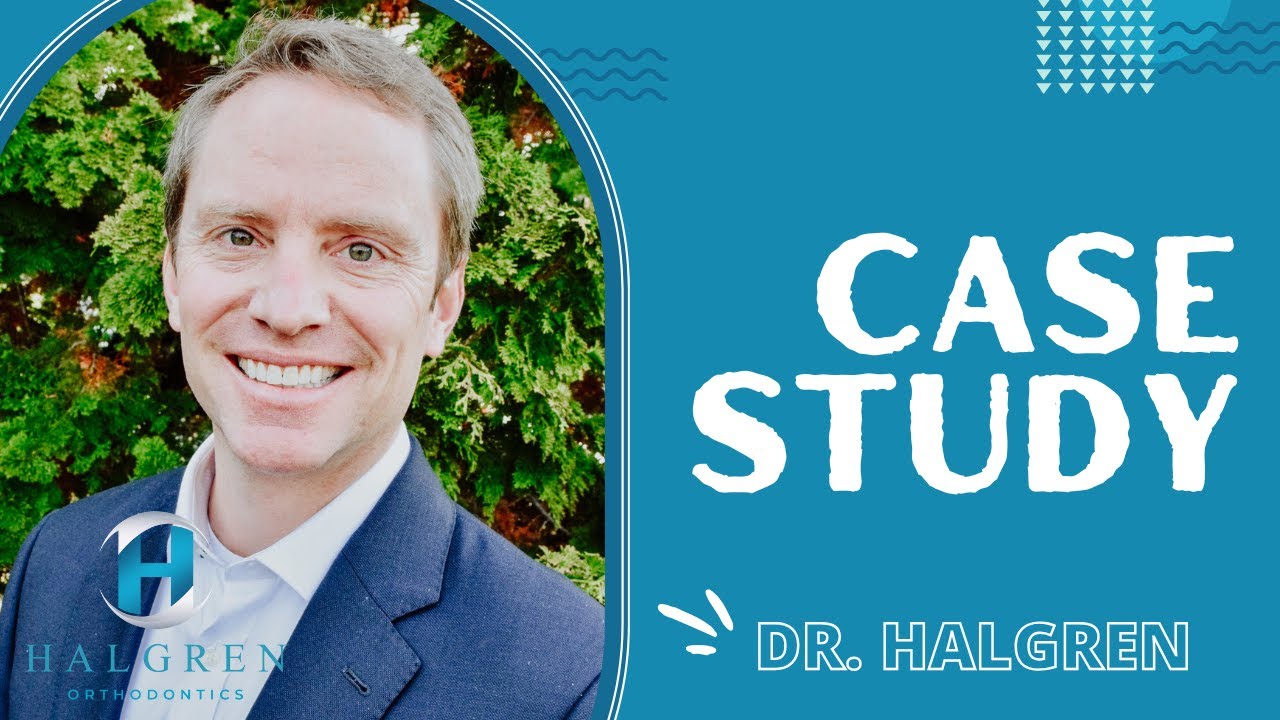 An Open Bite Case Study! Let's Dive in! | Orthodontist for Teens and Adults | Mount Vernon, WA