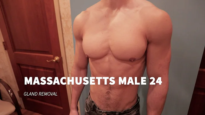 GYNECOMASTIA SURGERY:  MASSACHUSETTS MALE 24 GLAND...