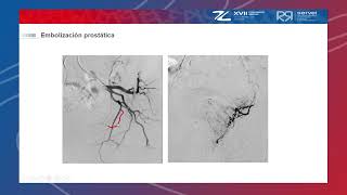 Embolización de próstata  Dr. Íñigo Insausti | Congreso SERVEI 2021