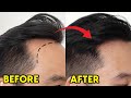 Hair Transplant Before & After - 1 Year Results