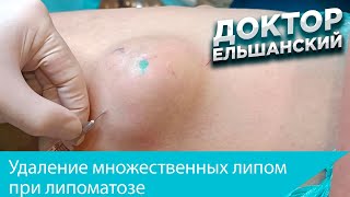 Удаление множественных липом при липоматозе