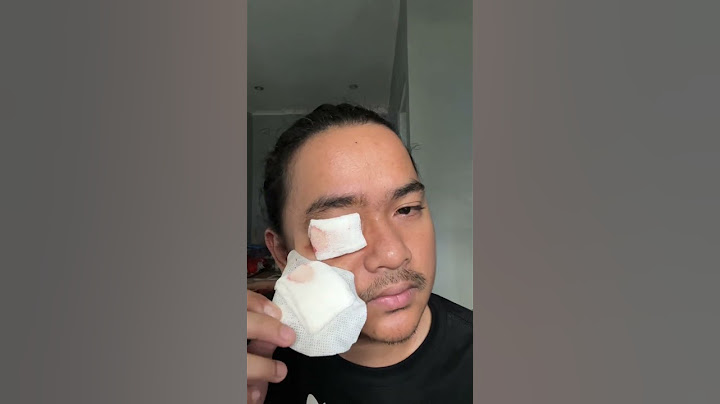 Buka Perban Pasca Operasi Pengangkatan Kalazion / Bintitan Bertahun-Tahun