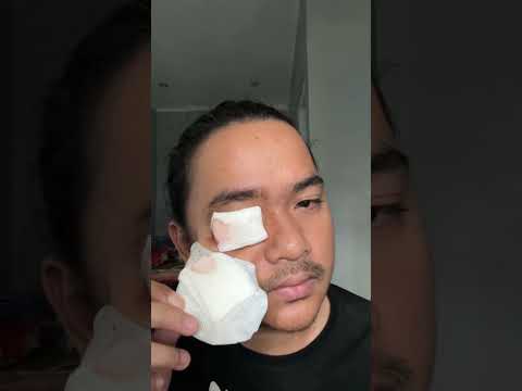 Video: Bolehkah bimatoprost digunakan pada kening?