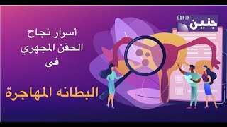 أسرار نجاح علاج البطانه المهاجرة في الحقن المجهري  -  شيكاجو 2019  !!