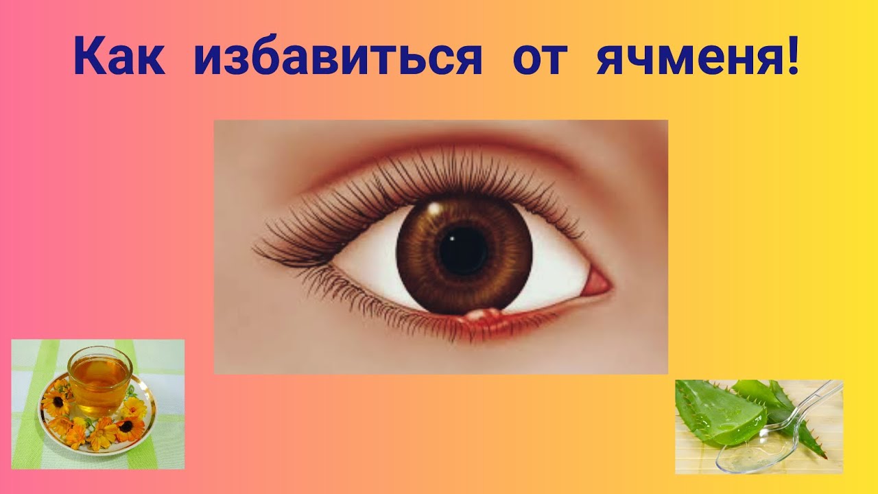 Как быстро вылечить ячмень у взрослого. Как выглядит ячмень на глазу.