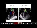 Teaching  learning discussion on tee for mitral stenosis and reguritation by dr  santosh ambli