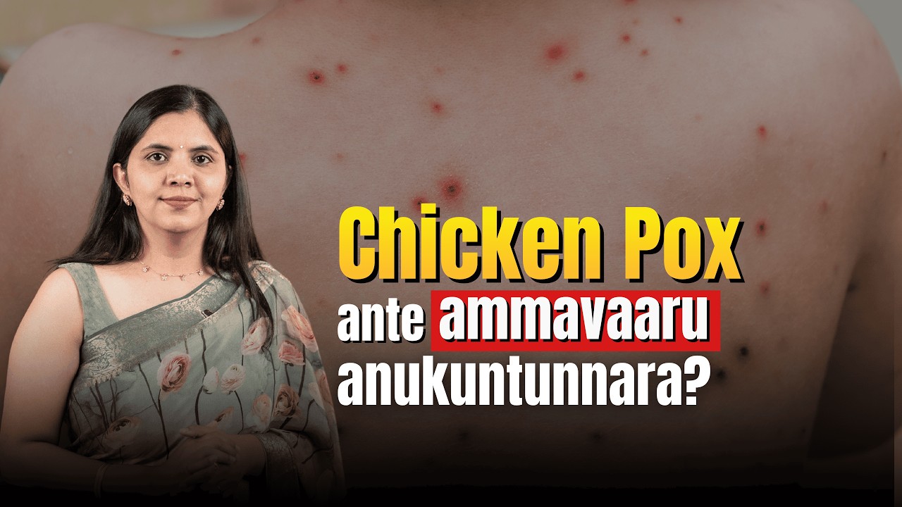 chicken pox ante ammavaaru anukuntunnara?