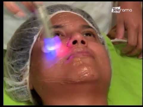 Tratamiento de radiofrecuencia facial