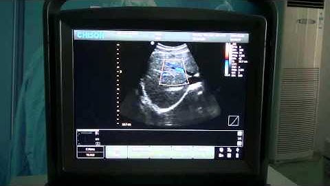 Chison ECO5 Ultrasound Demonstration | Vascular, Liver and Kidney Application