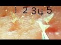 角栓どんどん抜いちゃうぞ!I pulled out keratinpkug continiously.