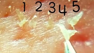 角栓どんどん抜いちゃうぞ!I pulled out keratinpkug continiously.