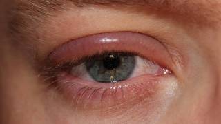 HOME REMEDIES TO REDUCE EYE SWELLING FROM CRYING