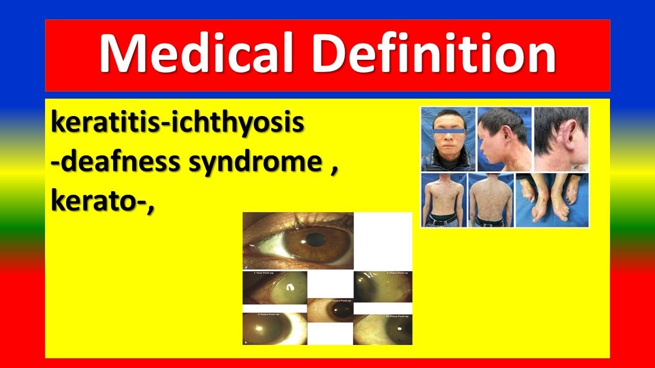 MEDICAL DEFINITION keratitisichthyosisdeafness syndrome ,kerato