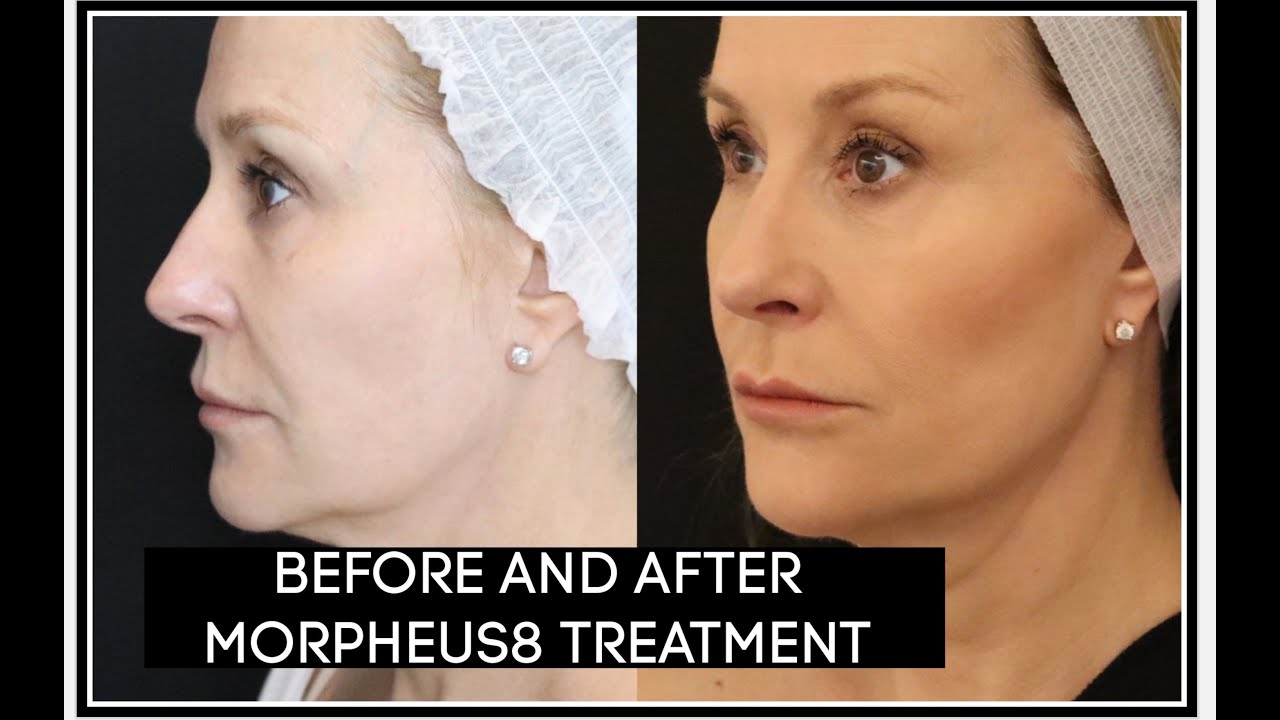 BEFORE AND AFTER MY MORPHEUS 8 TREATMENT - YouTube