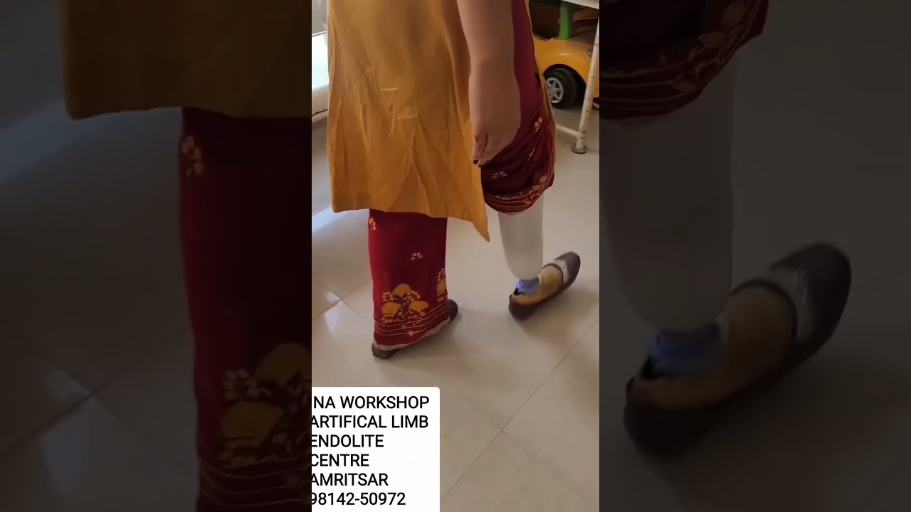 endolite below knee prosthesis