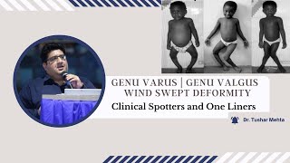 Genu Varus I Genu Valgus I Wind Swept Deformity Neet Pg, Ini-Cet, Fmge By Dr. Tushar Mehta