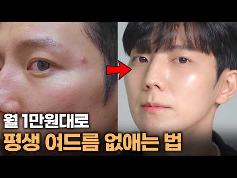 Stop Going to the Dermatologist and Try This at Home: My Special Routine for Acne-Free Skin for Life