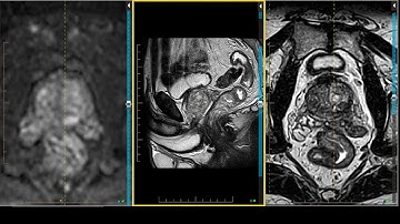Prostate MRI - Peripheral Zone Postrial Medial (PZpm) on MRI
