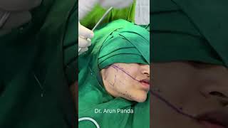 Cheek Liposuction for Sculpted Face | Performed by Dr Arun Panda at Bodyskulpt Aesthetics Mumbai