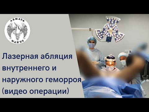 Лазерная абляция внутреннего и наружного геморроя (видео операции).