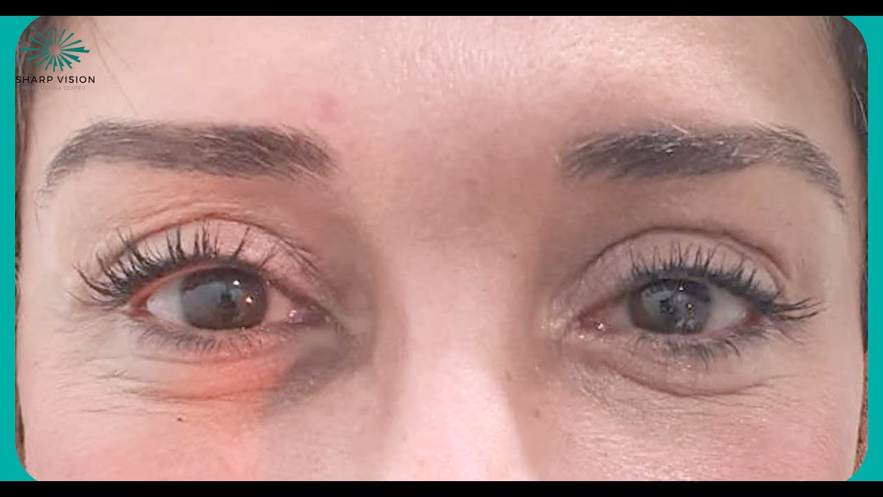 اهم الاسأله الي يتم طرحها عن قص الجفون