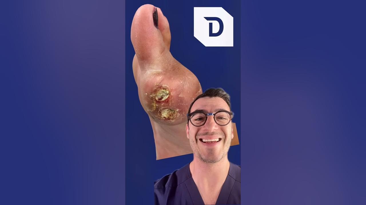 ABCs of Podiatry = G is for GOUT - YouTube