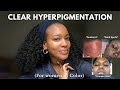 The Ultimate Hyperpigmentation Guide for Black Women