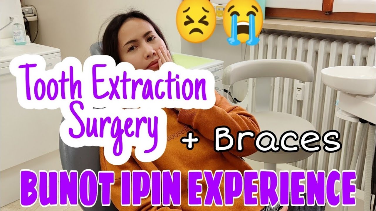 TOOTH EXTRACTION + BRACES | MY BUNOT IPIN SERYE SA ITALY