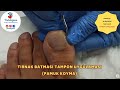 Tırnak Batmasında Tampon Uygulaması (Ev Uygulamaları)/Ingrown Nail Treatment/Podolog Zeliha Gökkaya