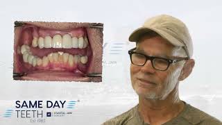 Same Day Teeth Patient Shares Experience Receiving Permanent Dental Implants At Coastal Jaw Surgery