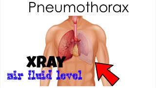 HYDROPNEUMOTHORAX xray findings | air fluid level