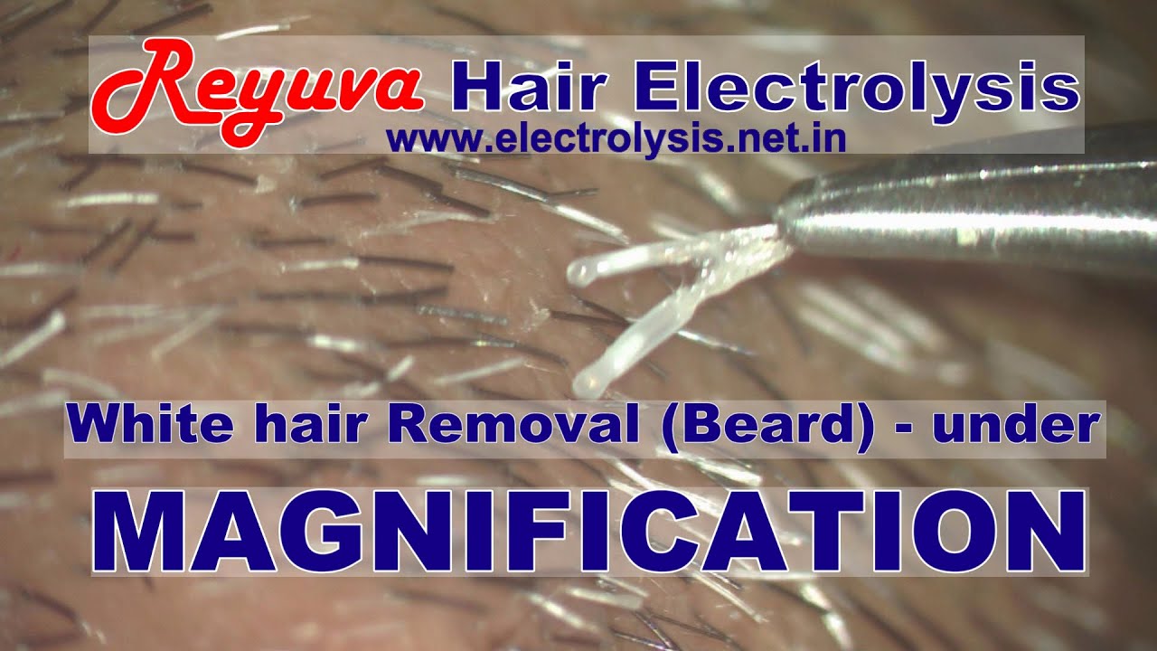 White hair removal Beard under high magnification YouTube