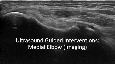 Ultrasound Guided Interventions: Medial Elbow (Imaging) #ultrasound