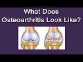 What Does Osteoarthritis Look Like?