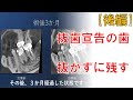 抜くと言われた歯を残す【後編】顕微鏡を使った根管治療内容　Endodontics | Root Canal Treatment