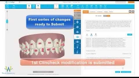 The Invisalign Clincheck Process from start to final approval video