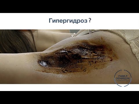 Сильно потеют подмышки? Тест на ГИПЕРГИДРОЗ