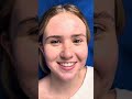 SeptoRhinoplasty with sinus surgery 2 1/￼2 years ago-breathing well and happy with ￼ appearance