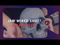 Jaw Wired Shut During an Airway Emergency. How to Fix it Even if You Don't Have Wire Cutters!!