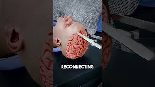 Brain Transplant Explained