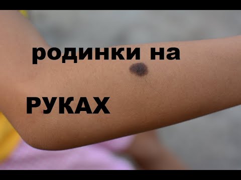 Видео: Что означает родинка в левой руке?