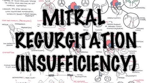 Mitral Regurgitation (incompetence)