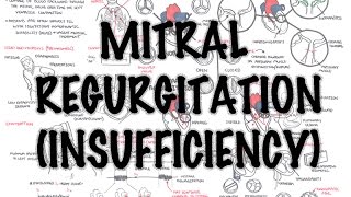 Mitral Reguritation (insufficiency)  Overview (signs and symptoms, pathophysiology, treatment)