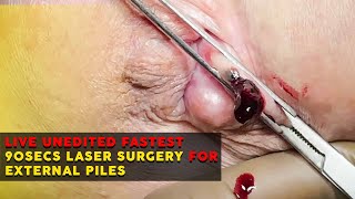 Live unedited fastest 90secs Laser Surgery for External Piles on American by Proctologist Dr Porwal screenshot 5